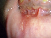 口内炎の写真(画像)１